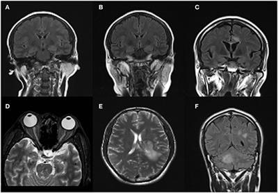 Co-occurrence of Anti-N-Methyl-D-Aspartate Receptor Encephalitis and Anti-myelin Oligodendrocyte Glycoprotein Inflammatory Demyelinating Diseases: A Clinical Phenomenon to Be Taken Seriously